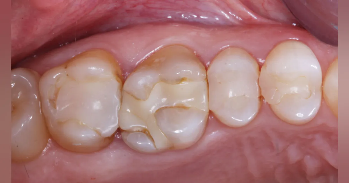 Large Tooth Restoration Do Composite Resin Restorations Protect Cracked Teeth? – POSQNH
