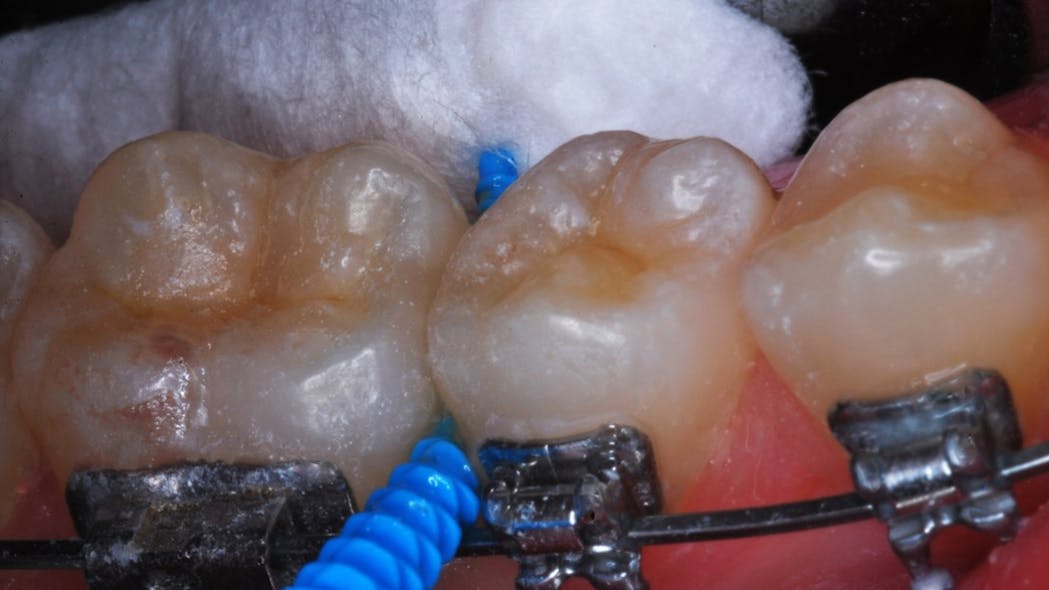 SDF application on posterior contacting axial surfaces in orthodontic ...