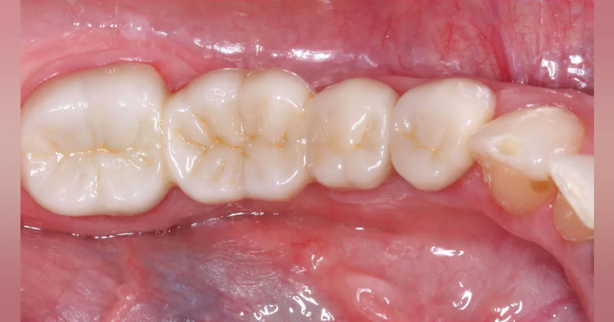 Successful dental restorations: Tips from an industry expert | Dental ...