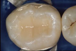 Figure 2: A direct pulp cap has at least a 60% chance to retain the vitality of teeth such as this.