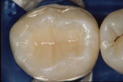 Figure 2: A direct pulp cap has at least a 60% chance to retain the vitality of teeth such as this. Figure 2: A direct pulp cap has at least a 60% chance to retain the vitality of teeth such as this.