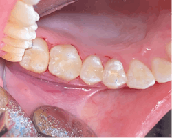 Figure 6: Postplacement of composite resins from figure 4. Tight and broad contacts with proper gingival-incisal form are created using the Composi-Tight system.