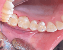 Figure 6: Postplacement of composite resins from figure 4. Tight and broad contacts with proper gingival-incisal form are created using the Composi-Tight system. Figure 6: Postplacement of composite resins from figure 4. Tight and broad contacts with proper gingival-incisal form are created using the Composi-Tight system.