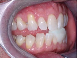 Figure 1: This patient is ready to have an interocclusal record made about 70% forward in incisal guidance for a sleep appliance (dreamTAP).