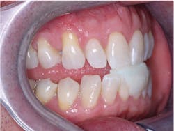 Figure 1: This patient is ready to have an interocclusal record made about 70% forward in incisal guidance for a sleep appliance (dreamTAP). Figure 1: This patient is ready to have an interocclusal record made about 70% forward in incisal guidance for a sleep appliance (dreamTAP).