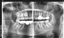 Figure 3: New technologies are rapidly coming on the market. This external bitewing radiograph was made on a cone beam device. This type of image offers significant advantages over conventional intraoral bitewings. Figure 3: New technologies are rapidly coming on the market. This external bitewing radiograph was made on a cone beam device. This type of image offers significant advantages over conventional intraoral bitewings.