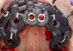 A carbon fiber composite surgical guide A carbon fiber composite surgical guide