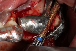 A printed titanium surgical guide guiding a zygomatic diamond drill to remove bone lateral to the sinus