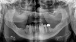 Figure 1: There are a variety of treatment plans for a patient such as this one. Some are relatively simple, while others are complex and expensive. Patients deserve to be informed in detail about all their options so they can make a logical decision about their treatment. Figure 1: There are a variety of treatment plans for a patient such as this one. Some are relatively simple, while others are complex and expensive. Patients deserve to be informed in detail about all their options so they can make a logical decision about their treatment.