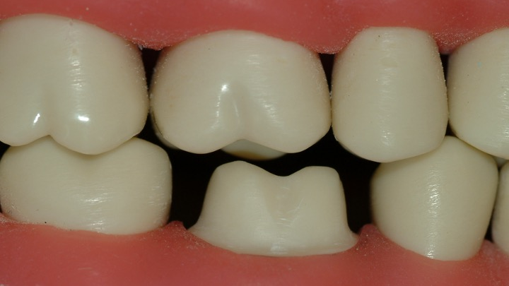 Figure 4: 1.5 mm to 2 mm occlusal reduction for both zirconia and lithium disilicate