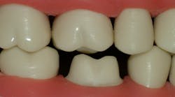 Figure 4: 1.5 mm to 2 mm occlusal reduction for both zirconia and lithium disilicate Figure 4: 1.5 mm to 2 mm occlusal reduction for both zirconia and lithium disilicate