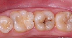 Figure 1: Tooth with caries of indeterminate depth. A radiograph will help you estimate if the pulp will be exposed, but only caries excavation will tell for sure. Excavate until the dentin is hard, place glutaraldehyde solution for two one-minute applications. Don’t worry about dentin discoloration. When properly used, the glutaraldehyde (MicroPrime from Zest Dental Solutions or other brands) kills the microorganisms and desensitizes the tooth. Figure 1: Tooth with caries of indeterminate depth. A radiograph will help you estimate if the pulp will be exposed, but only caries excavation will tell for sure. Excavate until the dentin is hard, place glutaraldehyde solution for two one-minute applications. Don’t worry about dentin discoloration. When properly used, the glutaraldehyde (MicroPrime from Zest Dental Solutions or other brands) kills the microorganisms and desensitizes the tooth.