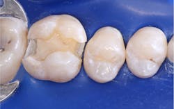 Figure 2: Maxillary molar with direct pulp cap placed on the distal aspect of the MOD. This treatment is successful most of the time, eliminating the need for endodontic treatment. Figure 2: Maxillary molar with direct pulp cap placed on the distal aspect of the MOD. This treatment is successful most of the time, eliminating the need for endodontic treatment.