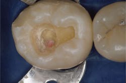 Figure 3: Pulp exposure on a mandibular molar. Now what? The technique described in this article is the same for an indirect or direct pulp cap. Figure 3: Pulp exposure on a mandibular molar. Now what? The technique described in this article is the same for an indirect or direct pulp cap.