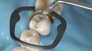 Hu Friedy Akro Flex Akro Flex Clinical Illustration 1 1911 5e6661cadd311 64c94987777f8