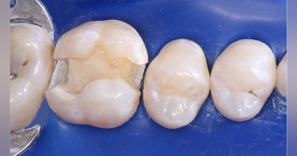 Tooth Sloth Endo Does that tooth really need endo? | Dental Economics