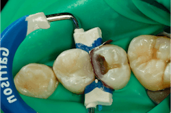 Figure 10: The second tooth is restored much like the first. Figure 10: The second tooth is restored much like the first.