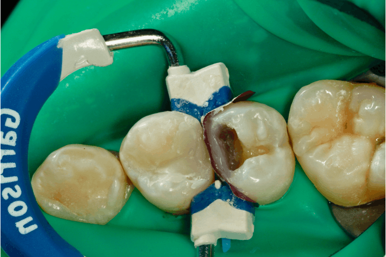 Figure 10: The second tooth is restored much like the first.