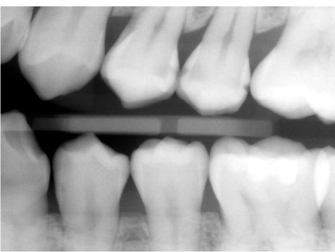 Figure 4: Bitewing radiograph of the patient