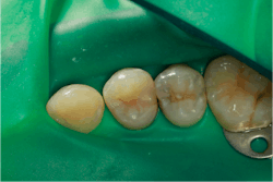 Figure 5: Rubber dam is applied. Figure 5: Rubber dam is applied.