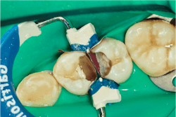 Figure 6: A sectional matrix is applied to each tooth with a single wedge and ring. Figure 6: A sectional matrix is applied to each tooth with a single wedge and ring.