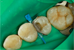 Figure 11: The separating ring is removed. Figure 11: The separating ring is removed.