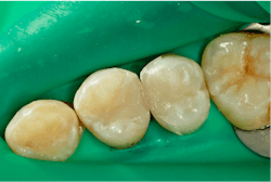 Figure 12: The flash on the midbuccal and midpalatal is easy to finish with a finishing bur or a disc. Figure 12: The flash on the midbuccal and midpalatal is easy to finish with a finishing bur or a disc.