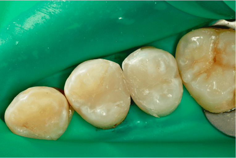 Figure 12: The flash on the midbuccal and midpalatal is easy to finish with a finishing bur or a disc.