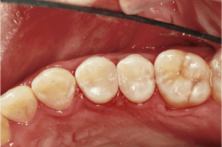 Figure 13: Figure 13: The restoration after a quick polish Figure 13: Figure 13: The restoration after a quick polish