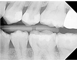 Figure 14: A post-op bitewing showing the successful restoration Figure 14: A post-op bitewing showing the successful restoration