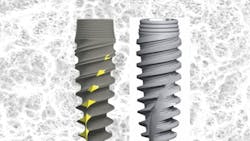 Figure 1: Left: the Ultimate implant by Ditron Ltd (designed by prosthodontist Dr. Mateo Danza). Right: the early Nobel Active by Nobel BioCare (designed by Fromovich and Danza). Figure 1: Left: the Ultimate implant by Ditron Ltd (designed by prosthodontist Dr. Mateo Danza). Right: the early Nobel Active by Nobel BioCare (designed by Fromovich and Danza).