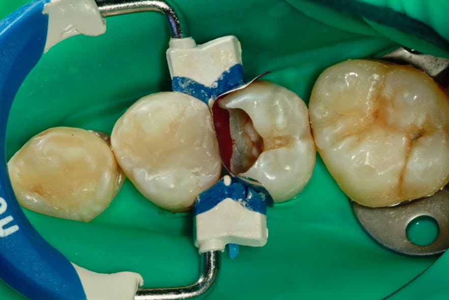 Figure 9: The rubber dam at this stage prevents contamination.