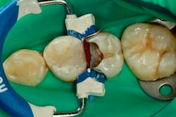 Figure 9: The rubber dam at this stage prevents contamination. Figure 9: The rubber dam at this stage prevents contamination.