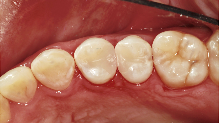 The most challenging everyday restorative problem: A case study in adjacent interproximal composite restorations