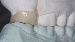 Figure 3: This ceramic crown is about 0.5 mm too low, a common issue with labs. Figure 3: This ceramic crown is about 0.5 mm too low, a common issue with labs.