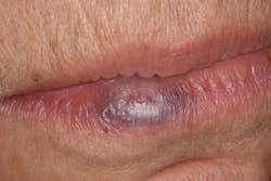 Figure 2: Hemangioma (venous lake) Figure 2: Hemangioma (venous lake)