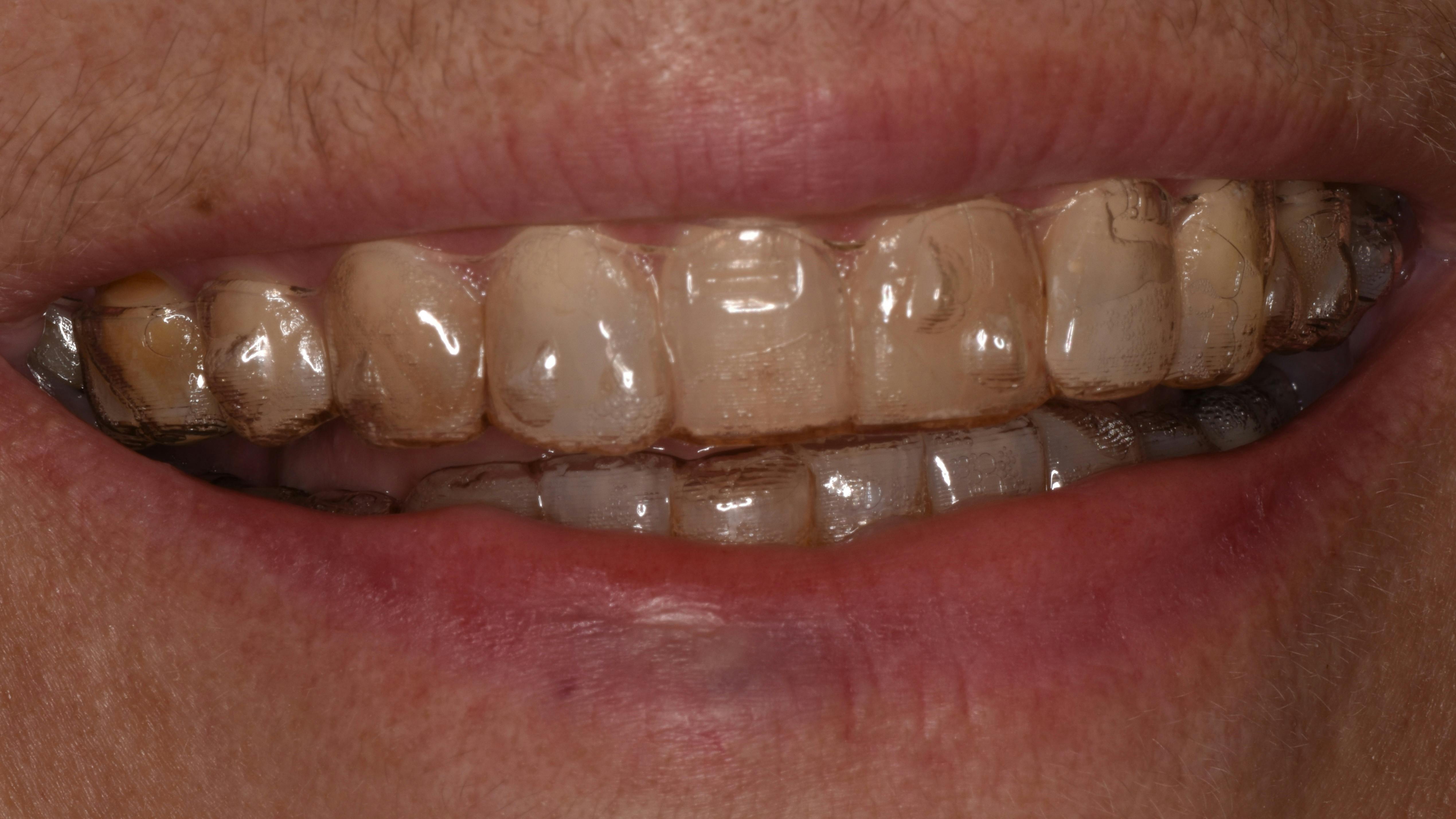 Figure 1: Teeth lengthening not limited to amount of bone present