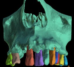 Figure 1: AI-driven bone and teeth segmentation in implant planning software