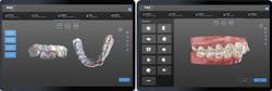 Figure 2: AI-driven teeth segmentation and treatment plan generation in Neural Hive’s Kea orthodontic software Figure 2: AI-driven teeth segmentation and treatment plan generation in Neural Hive’s Kea orthodontic software