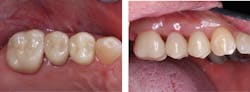 Figure 4: Left to right: full zirconia, zirconia-based, and lithium disilicate. There&rsquo;s not much difference in appearance with superficial stain and glaze. Long-term research is still needed.