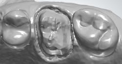 Figure 4: The retraction paste is placed, and the scan is completed. Figure 4: The retraction paste is placed, and the scan is completed.