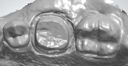 Figure 5: A small-diameter retraction cord is placed to visualize and prepare the margins. Figure 5: A small-diameter retraction cord is placed to visualize and prepare the margins.