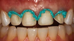 Voco Retraction Paste Voco Retraction Paste