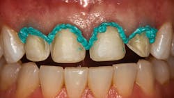 Voco Retraction Paste Voco Retraction Paste