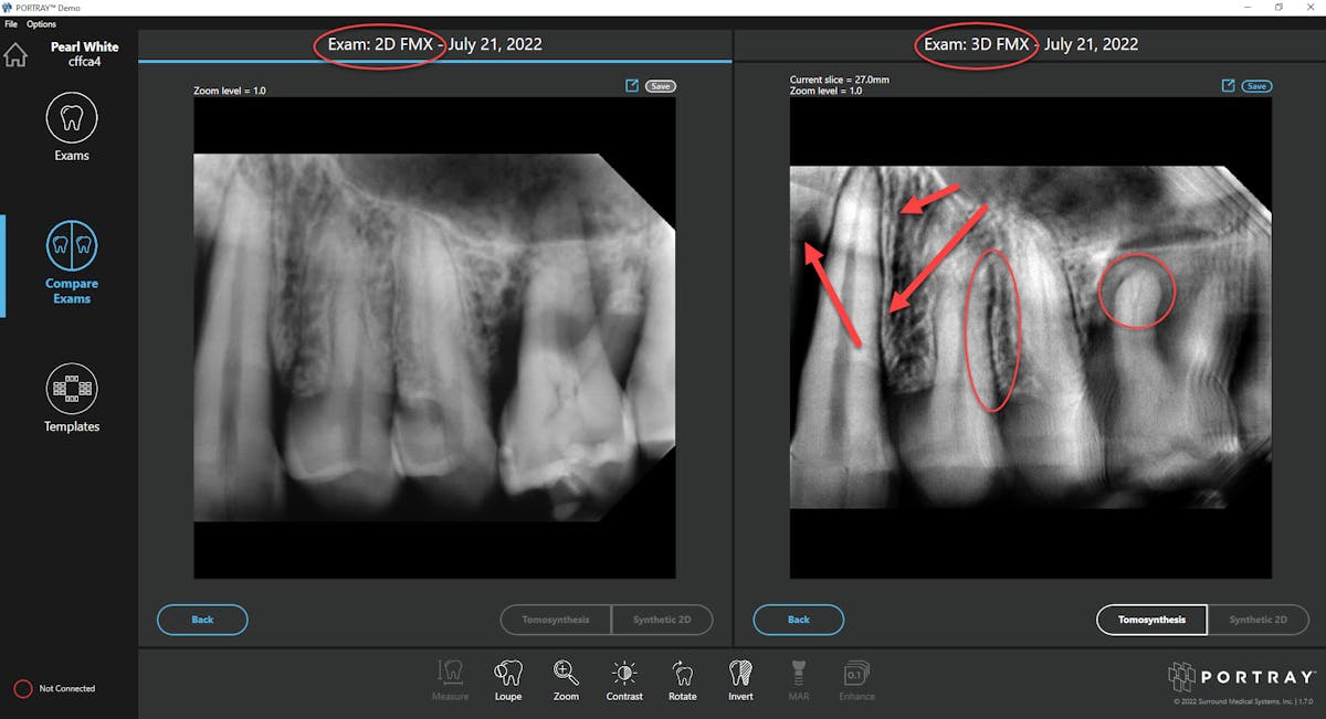 3D tomosynthesis The future of dental imaging allows you to see more