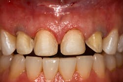 Figure 1: The tissue is mildly irritated after removing the veneer temporaries. Figure 1: The tissue is mildly irritated after removing the veneer temporaries.
