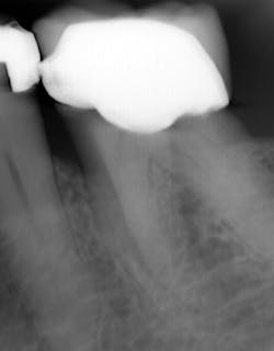 Figure 2: 2D showing a periodontal pocket