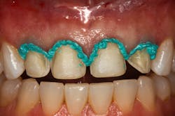 Figure 2: Retraction paste is placed on the tissue for two minutes. Figure 2: Retraction paste is placed on the tissue for two minutes.
