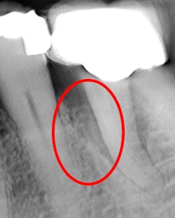 Figure 3: 3D tomosynthesis showing a periodontal pocket Figure 3: 3D tomosynthesis showing a periodontal pocket