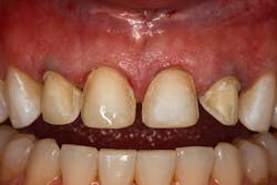 Figure 3: Margins are visible once bleeding is controlled, sulcular fluids are dried, and tissue is slightly retracted. Figure 3: Margins are visible once bleeding is controlled, sulcular fluids are dried, and tissue is slightly retracted.